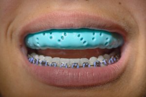 How to Choose a Mouthguard – The Complete Guide
